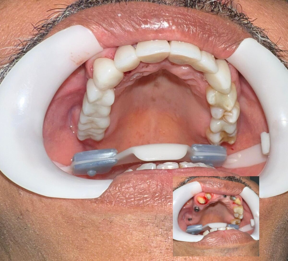 Before and after - full-mouth reconstruction