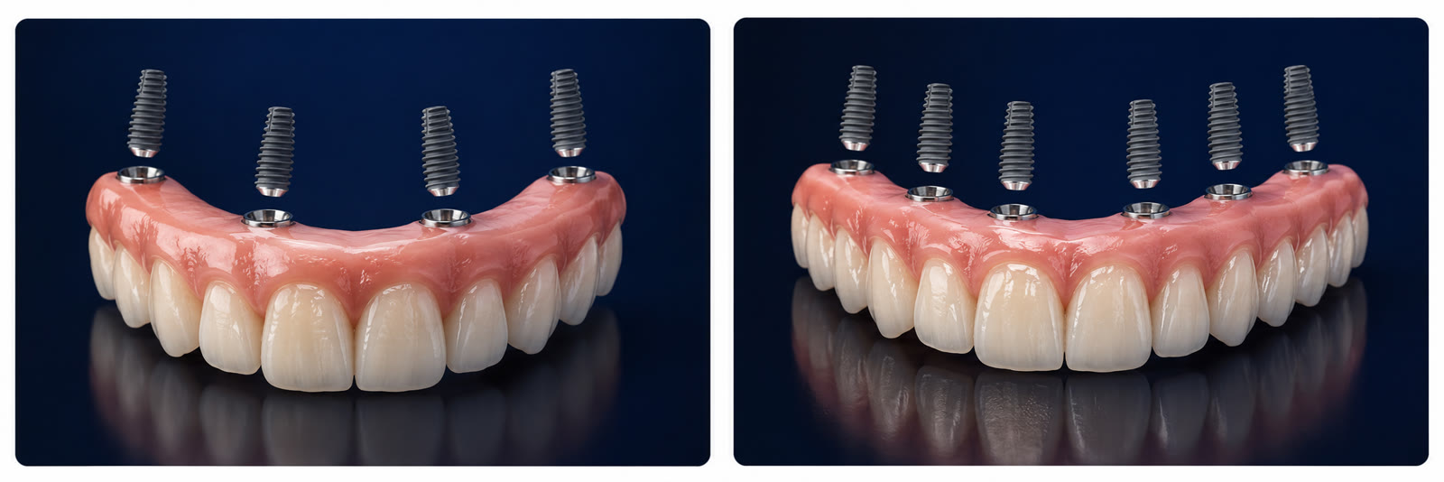 All-on-4 and All-on-6 fixed teeth on implants